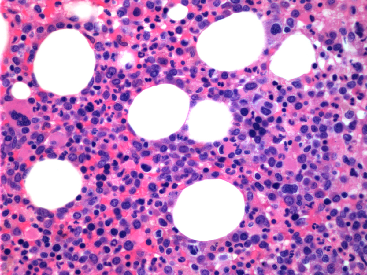 Bone marrow biopsy (high power)